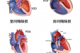 医院心血管三部成功独立开展2例卵圆孔未闭封堵术、1例房间隔缺损封堵术